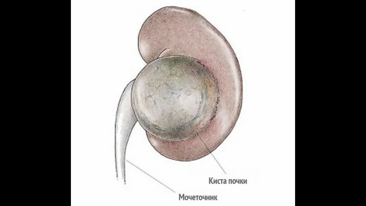 Киста в почке у мужчин причины