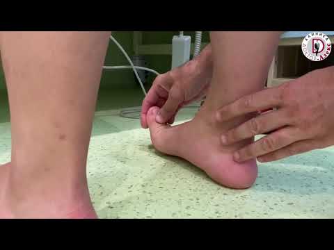 Вальгусная деформация стопы или Hallux valgus