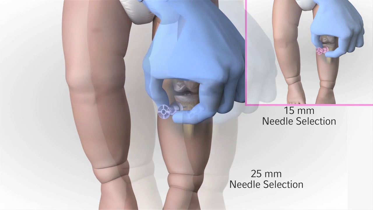 Key Concepts ARROW® EZ-IO® Intraosseous Vascular Access System - Ppt