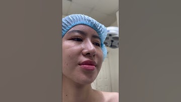 Khám lại ca nâng mũi cấu trúc dựng trụ sau 6 tháng