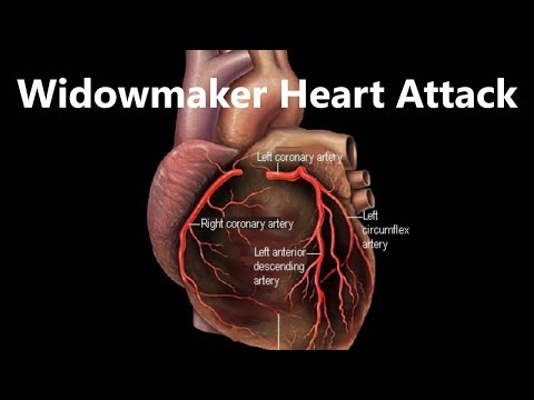 I had a Massive Widowmaker Heart Attack