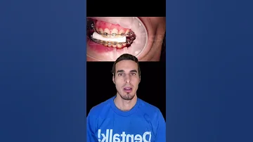 ¿Cuál es el último paso antes de retirar los brackets?