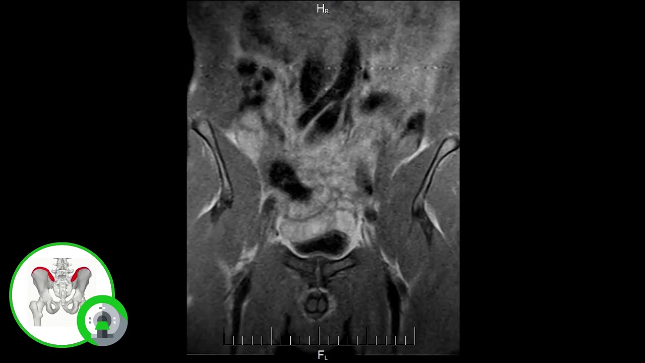 МРТ тазобедренного сустава (что видно на снимках)