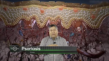 ¿Qué usan los chinos para la psoriasis?