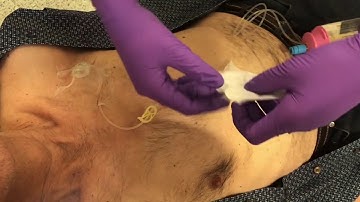 Afsluiten elastomeerpomp met antitumorale middelen