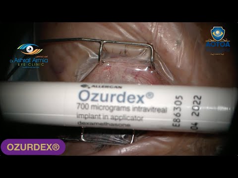 OZURDEX® (dexamethasone intravitreal implant) Injection Technique and Indications. Dr  Ashraf Armia