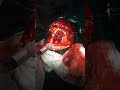 Brain clot removal and hitch stiches (Bi Frontal extra dural hematoma).