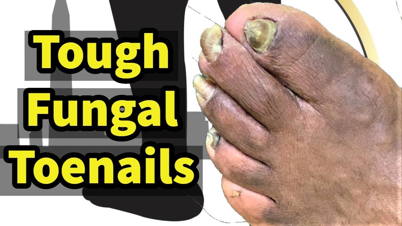 Tough Fungal Toenails Treating and trimming thick fungal toenails