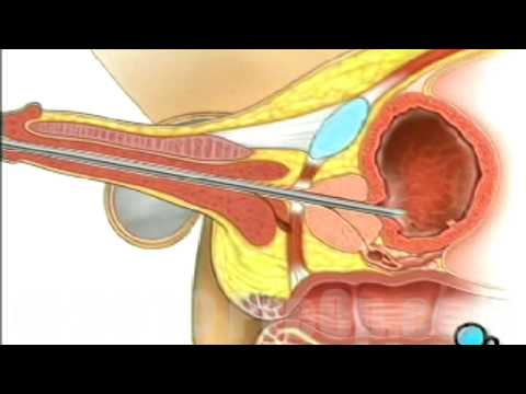 Oncology Patient Education Cystoscopy Penis Male