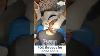 Pdo Threads For Acne Scars Acne Scars Treatment Live Procedure