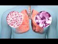 Lung cancer early diagnosis treatment