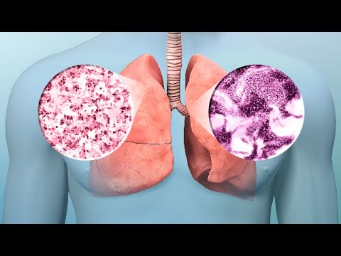 Video: Hoe longkankersymptomen te identificeren (met afbeeldingen)