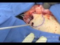 Supraorbital Craniotomy Bony Exposure