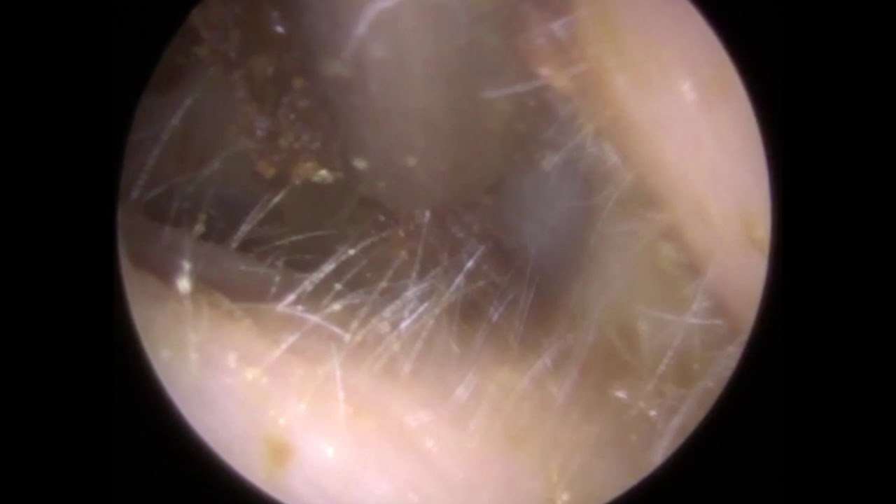 'Elastic' Ear Wax Removal using Endoscopic Microsuction 331 YouTube