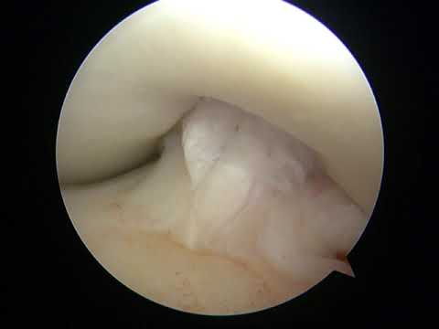 Ligamentoplastie genou - Ligament croisé antérieur - 2/2