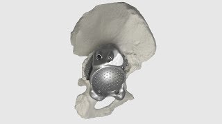 PME Planner - Flanged acetabular cup with augment