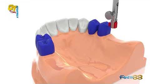 Milling-Free Partial Denture Project: OT Strategy + Steady Attachment System