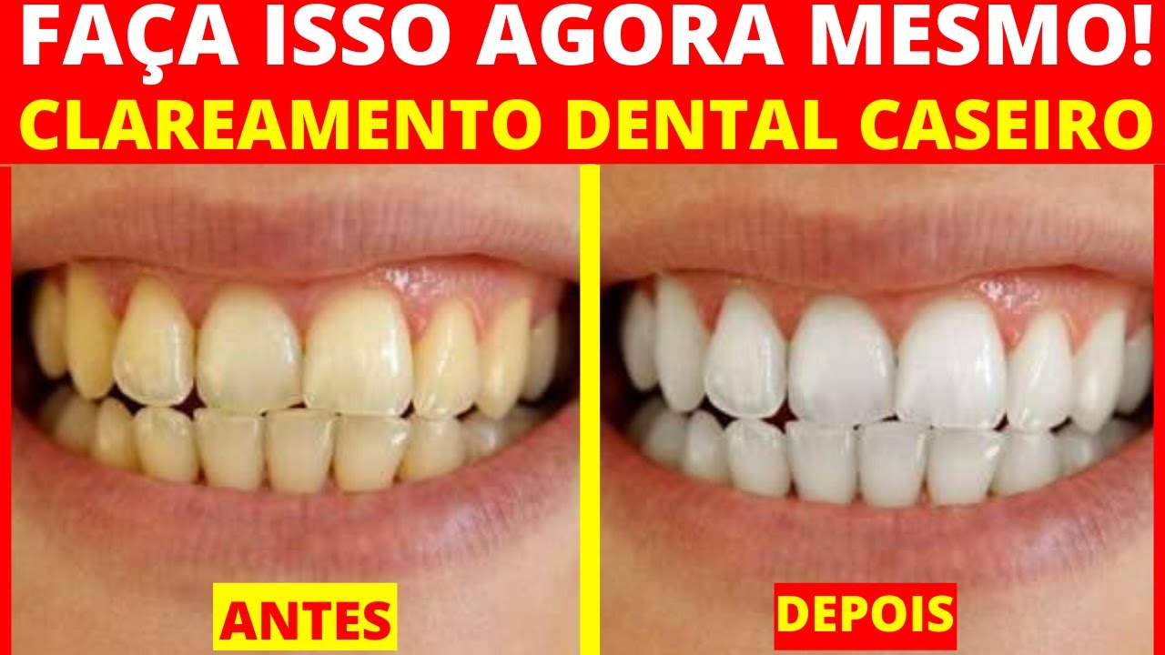 Clareamento dental caseiro, Clareamento dental, Como clarear os dentes, dicas de clareameno Clareamento dental caseiro, Clareamento dental, Como clarear os dentes, dicas de clareameno