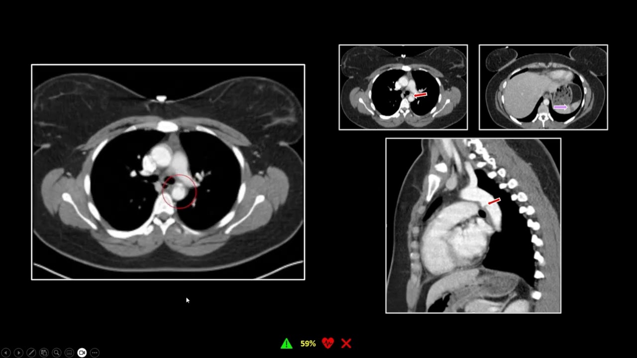 Thoracic Trauma CT: Part 1 (Aorta) | Free Radiology CME