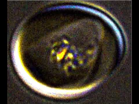 Malaria Iron Crystal