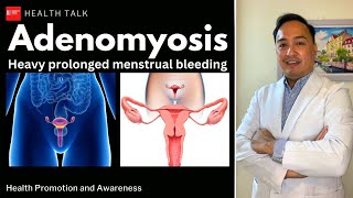 Do you have heavy prolonged menstrual period? Baka Adenomyosis na yan?