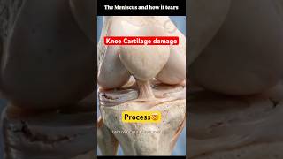 🦵Knee carilage damage #kneejointpain#meniscus #cartilage #synovialfluid#physiotherapy #medicosstuff