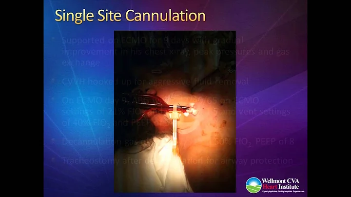 ECMO & Your Hospital
