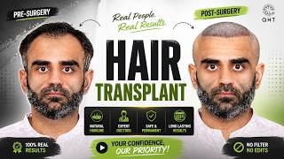 Information Hair Transplant in Chennai (HX-ZCNN) | Best Results & Cost of Hair Transplant in Chennai Guide