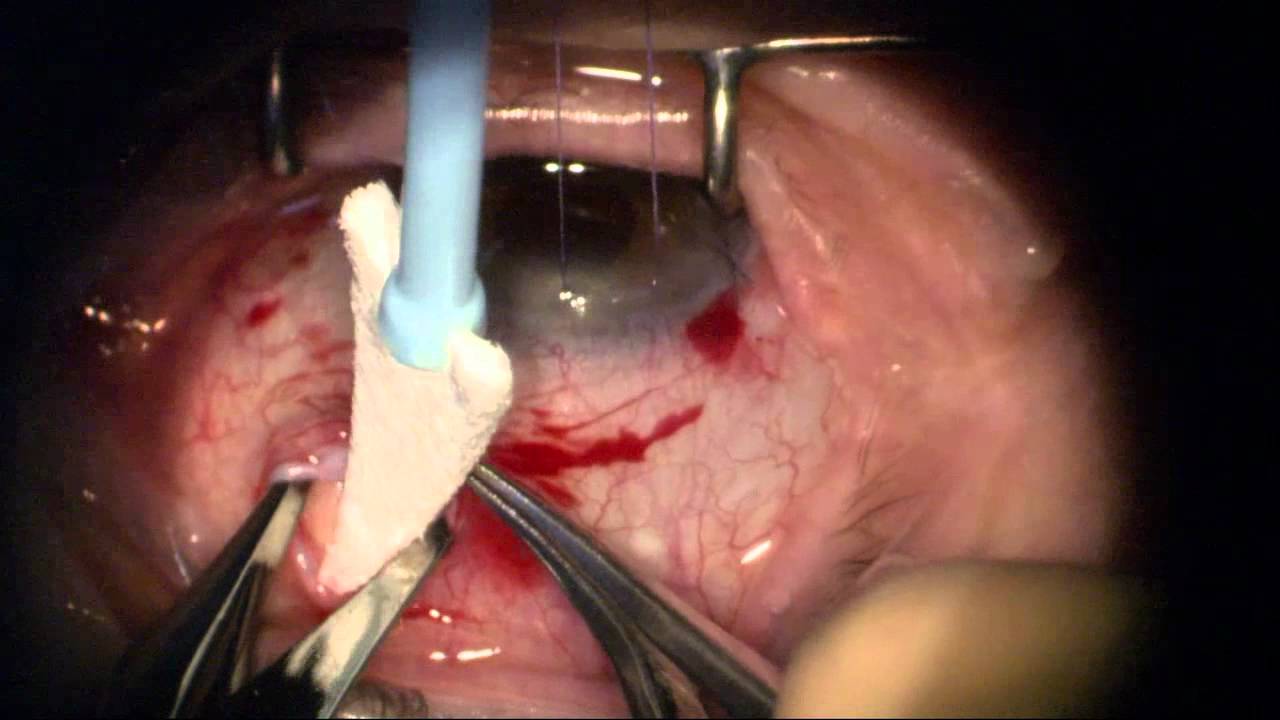 Combining Cataract and Surgery YouTube