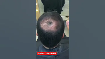 Thinning Hair Concealer Hair Transformation 