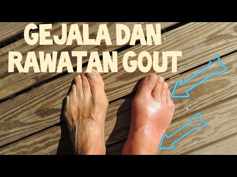 Gejala dan rawatan penyakit gout