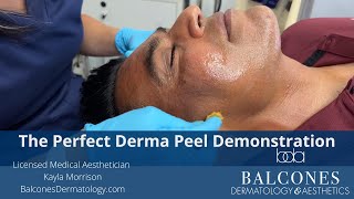 The Perfect Derma Peel Demo Balcones Dermatology & Aesthetics Austin, Tx Ph512-459-4869