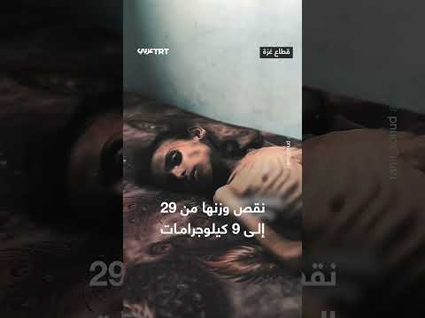 طفلة فلسطينية من غزة تعاني سوء تغذية حاداً بسبب التجويع