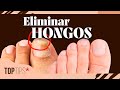 Cómo eliminar hongos en las uñas de los pies