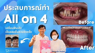 ประสบการณ์ทำ ALL ON 4 รากฟันเทียมยึดกับฟันปลอมทั้งปาก | DR.NALAT