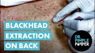 Blackhead Extraction On Back! Throwback Thursday Blackhead