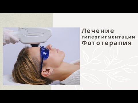 Лечение гиперпигментации. Фототерапия.