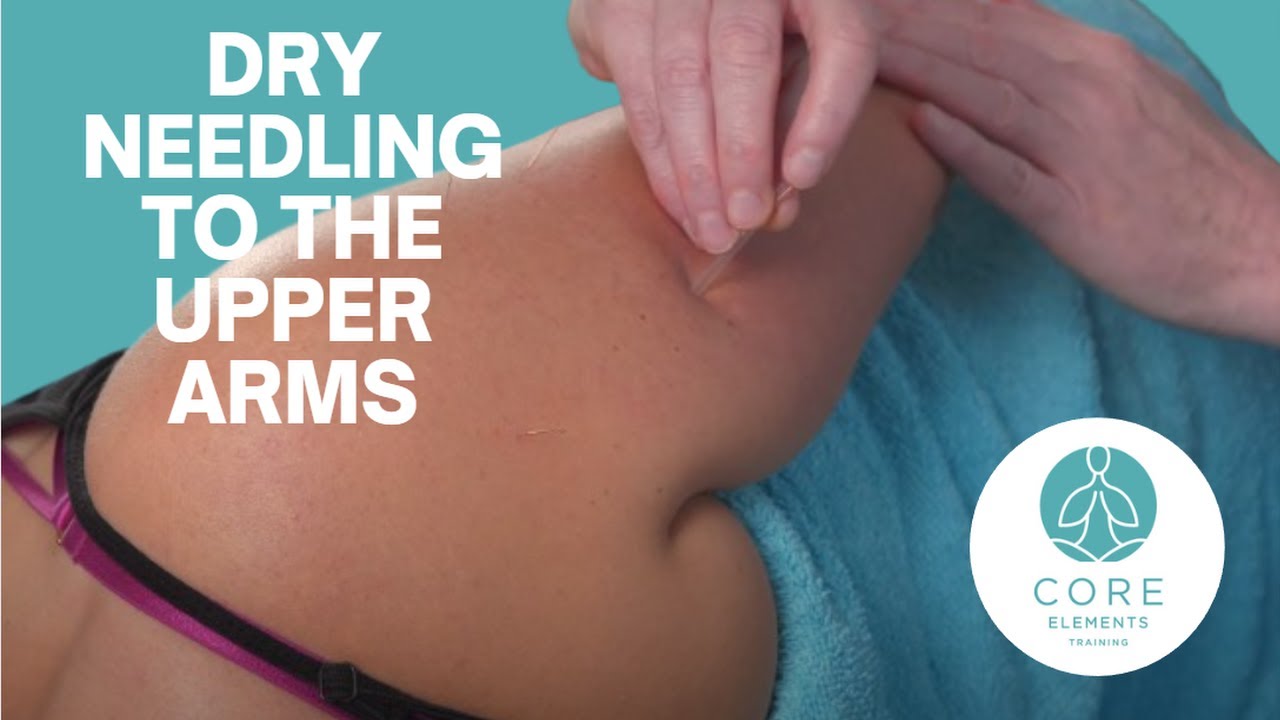 Клиническая сухая иглотерапия в области плеча — уменьшение боли и увеличение подвижности