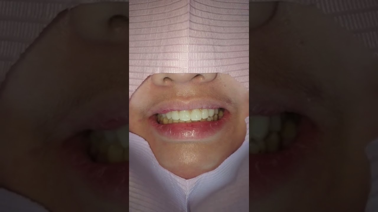 Zirconia Fixed Bridge