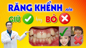 Răng Khểnh Đẹp Hay Xấu? Có Nên Niềng Răng Khểnh Không | Nam Bùi Vinalign