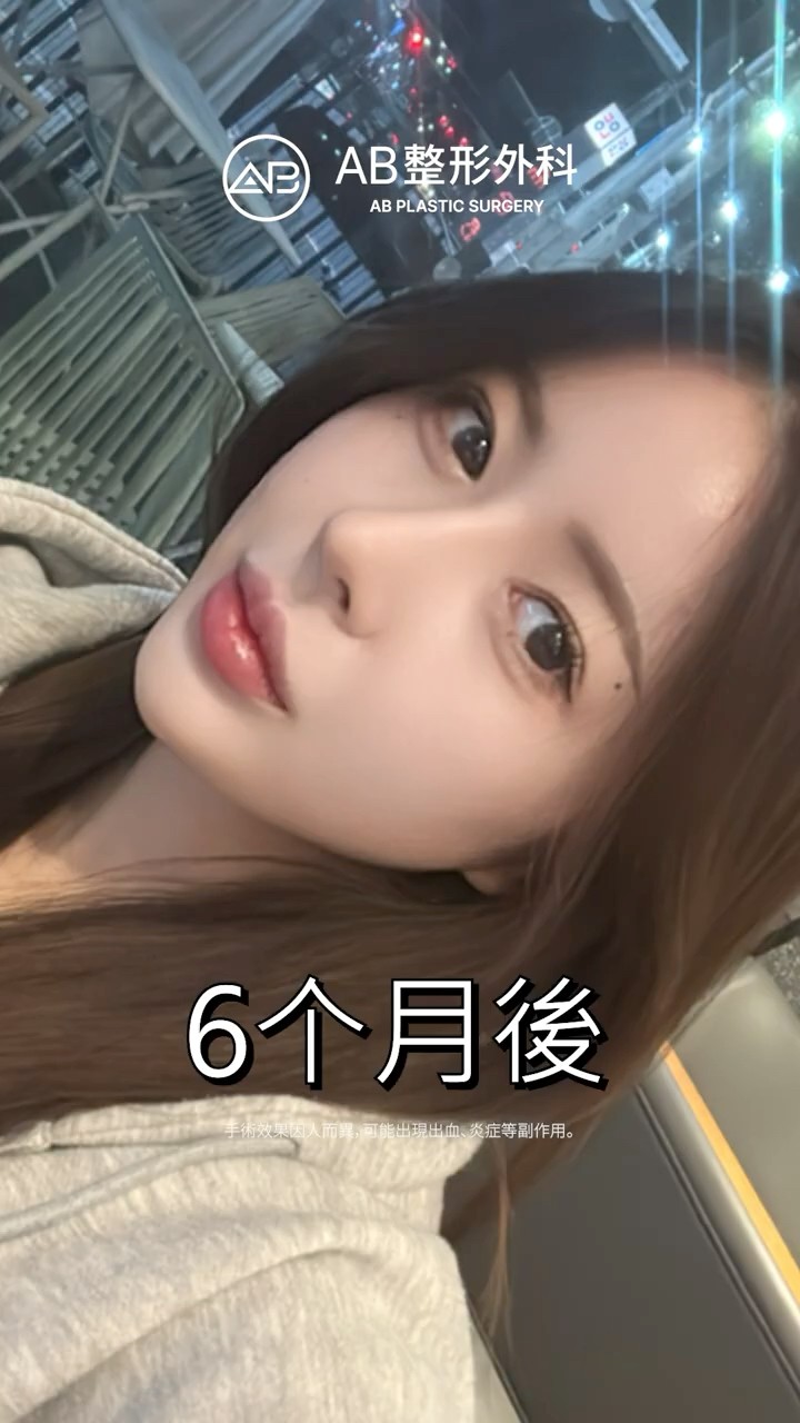 鼻整形後，連側臉都變精緻了✨ #Shorts