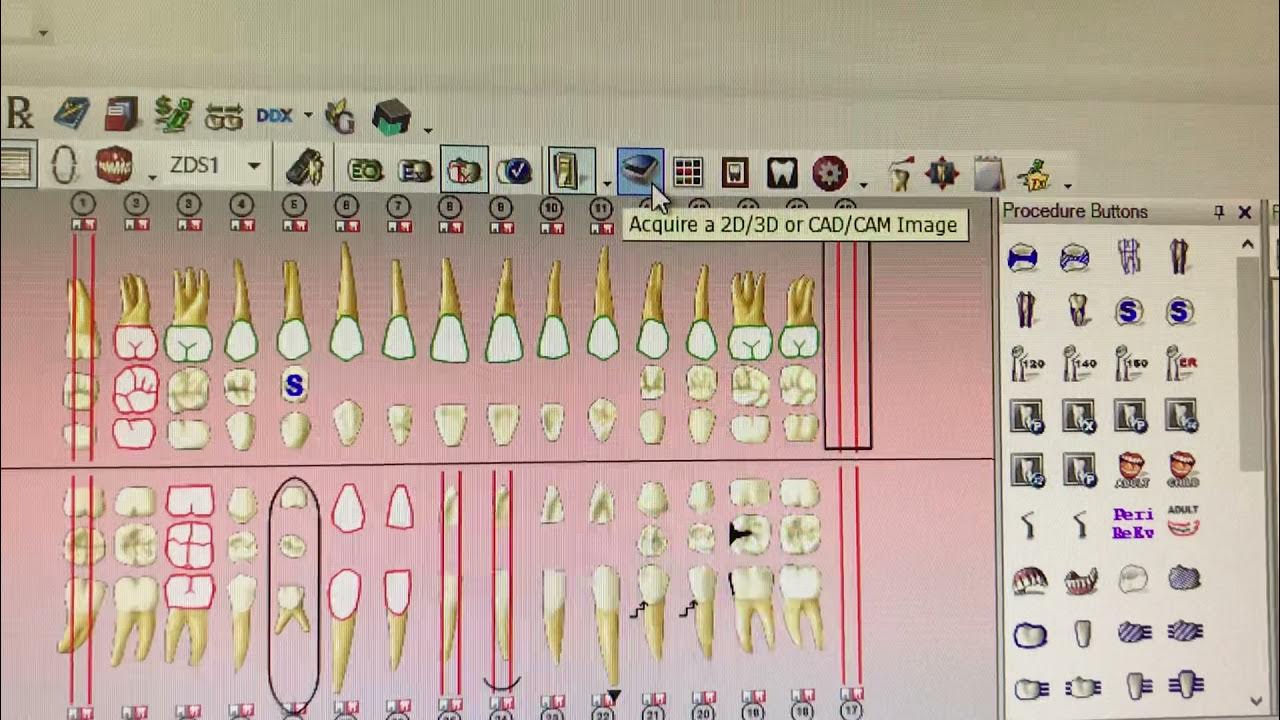 How to take Intraoral photos Dentrix Imaging System YouTube