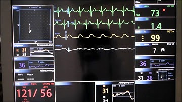 Deviation of Indices Spectral Entropy during Propofol Bolus