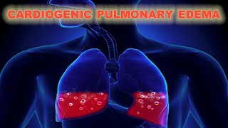 Cardiogenic Pulmonary Edema - CRASH! Medical Review Series