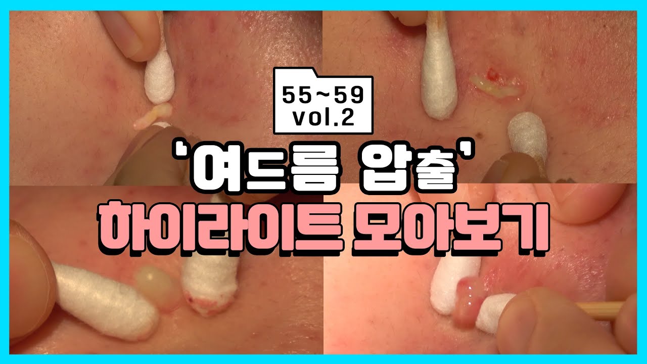 [압출킹 하이라이트] 🕛새해에도 시원하게!🕝 여드름 압출 ASMR 하이라이트 모아보기 14편 썸네일