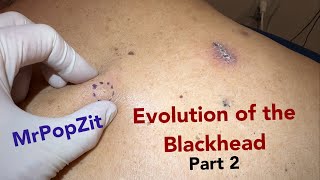 Evolution of the blackhead part 2. Great visual dissection of the pathway from pore to cyst.