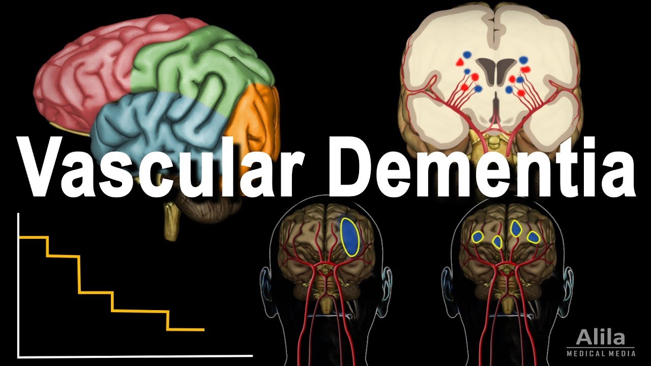 Vascular Dementia Pathology, Animation