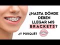 ¿Hasta dónde deben llegar mis backets y por qué?