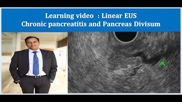 Linear EUS, Learning video, chronic pancreatitis Pancreas divisum, Dr Vikas Singla