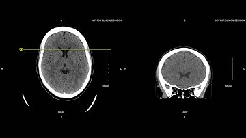 Unremarkable Non-Contrast CT Coronal Scan - Example 2